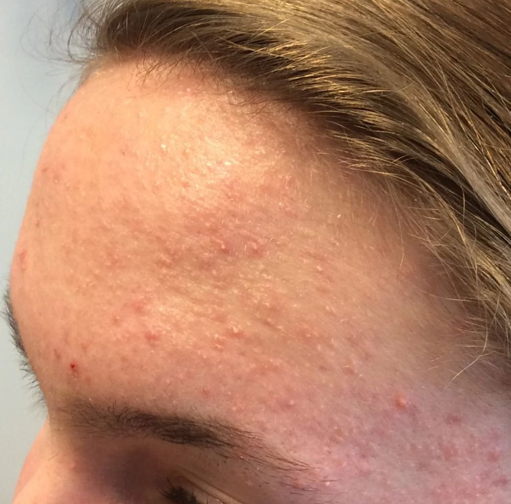 Folliculitis