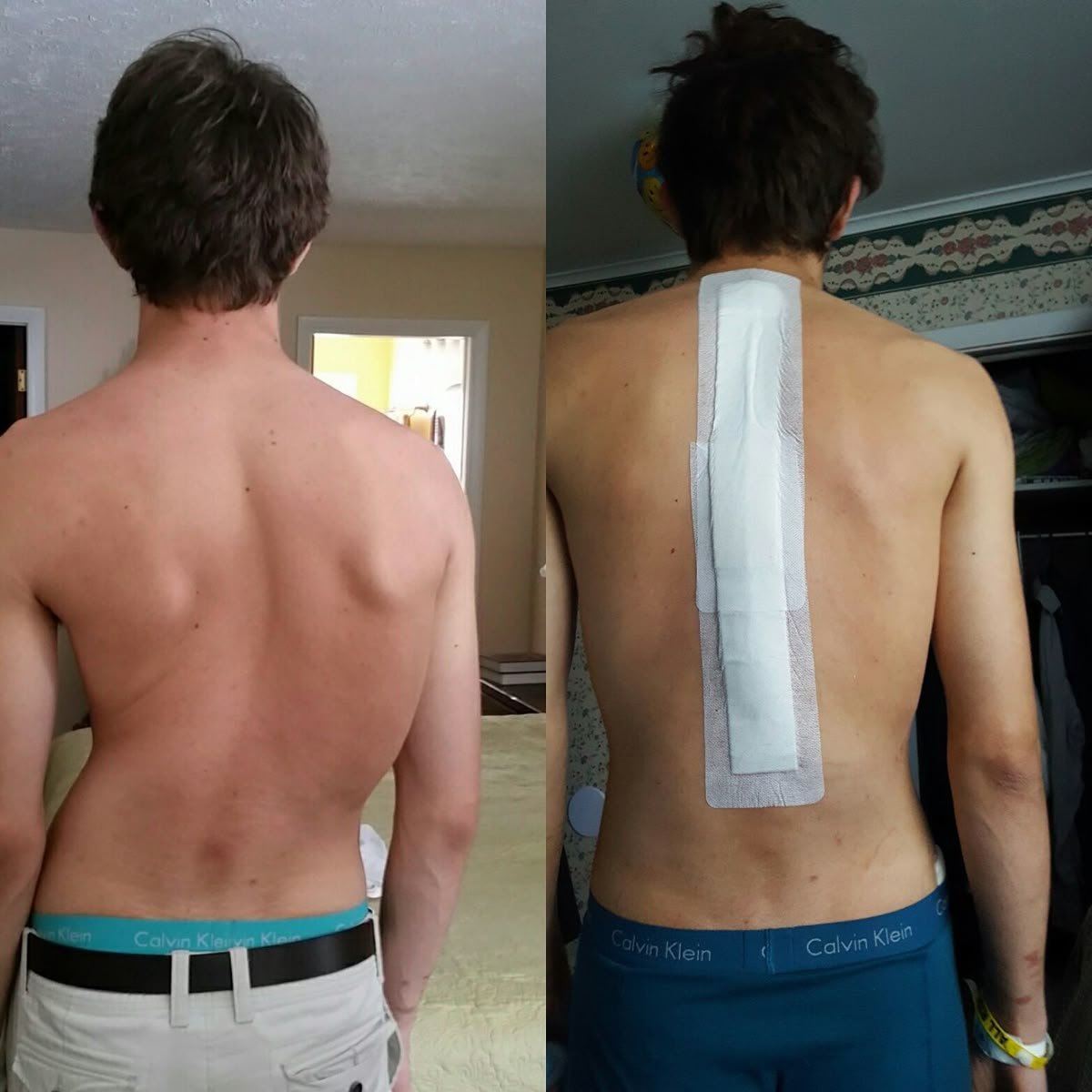 Scoliosis