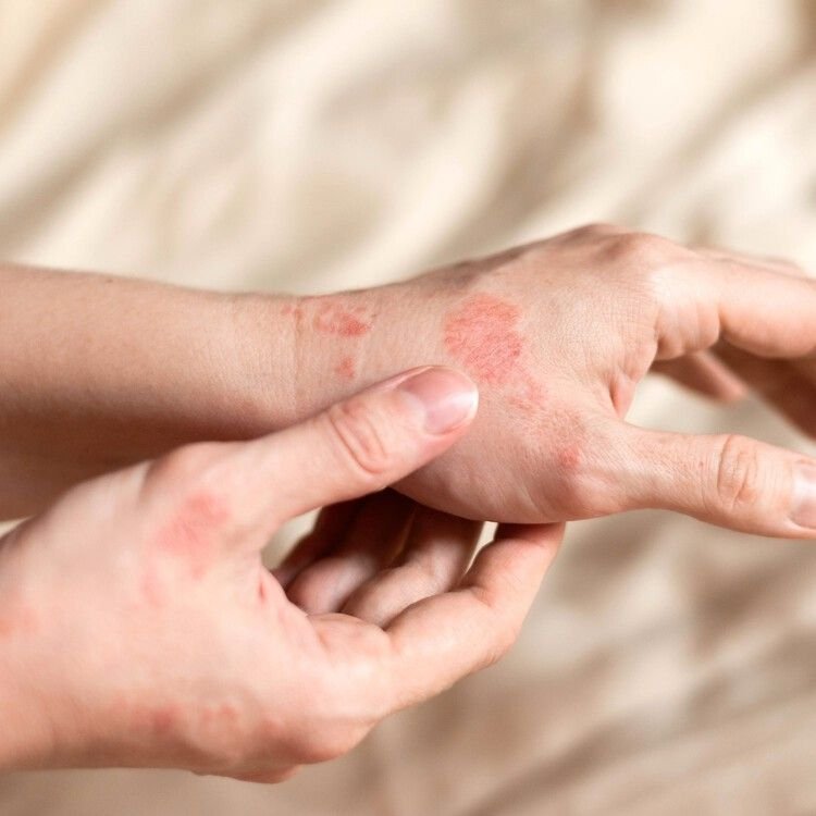 Eczema