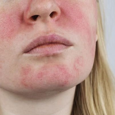 Dermatitis