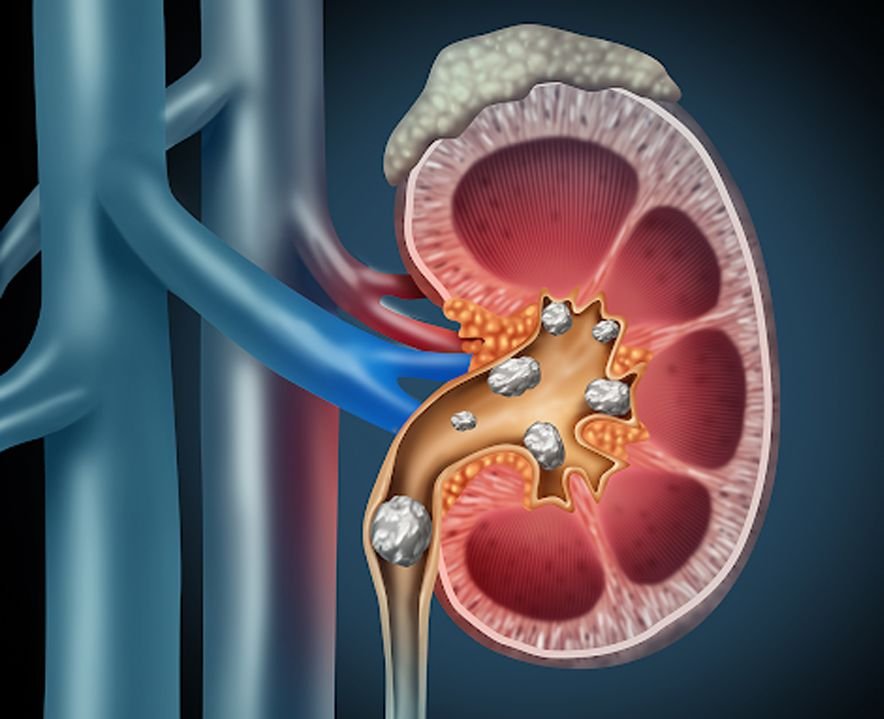 kidney stone