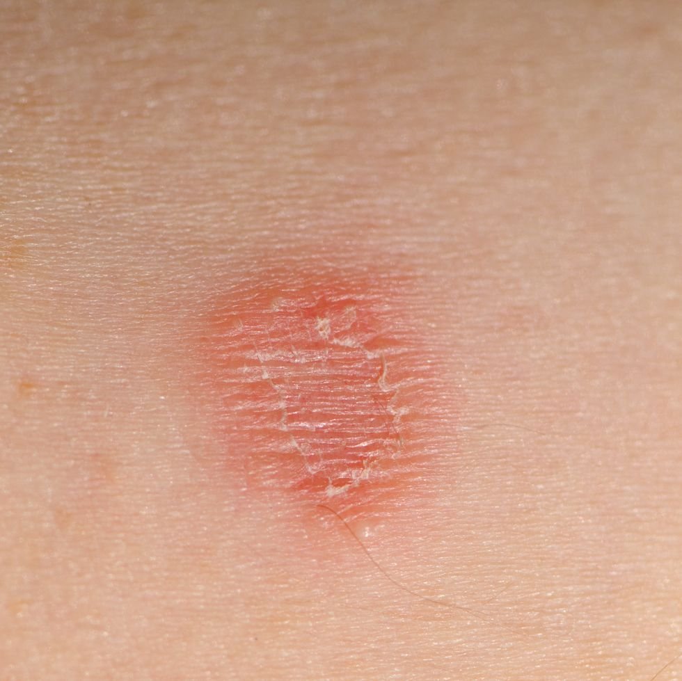 Ring worm infection