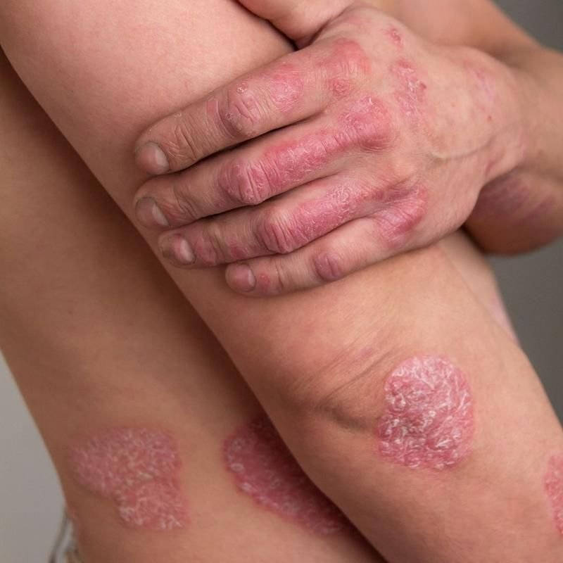 Psoriasis