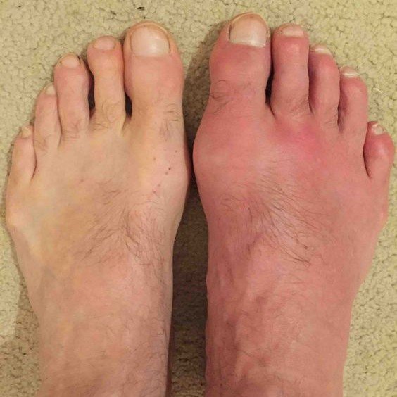 Gout