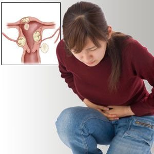 Fibroid Uterus